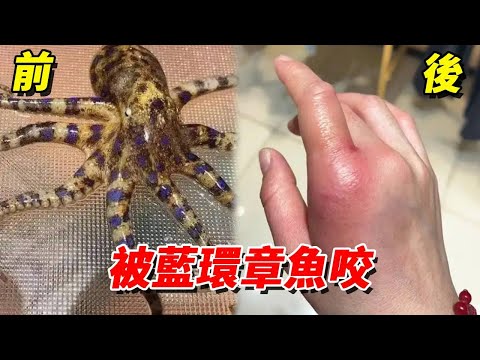 藍環章魚毒性有多猛？光是輕微咬傷就導致手部紅腫，看完再也不敢碰了!【王小怪】