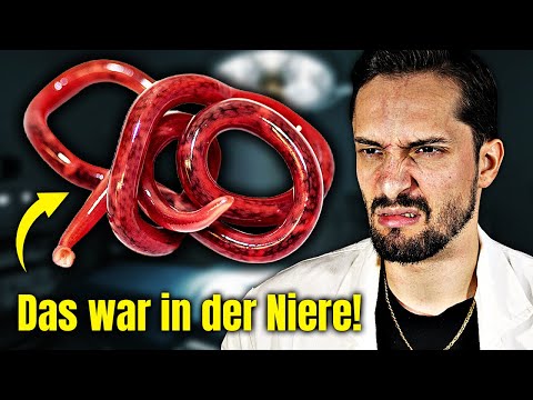 A 30 cm long parasite suddenly appears in the kidney! A biologist explains.