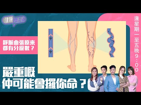 健康關注組 ｜ 靜脈曲張原來都有分級數？嚴重嘅仲可能會攞你命？ ｜ HOY TV 77台 ｜ 郭田葰 ｜ 黃芳雯 ｜ 林曉蕙 ｜ 第43集