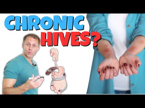 Why Do I Have Chronic Hives (Urticaria)