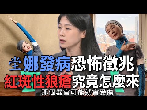 紅斑性狼瘡究竟怎麼來？坣娜發病恐怖徵兆 !新聞挖挖哇