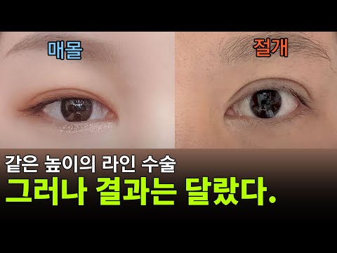 라인을 높게 잡아서 소세지가 된 거 같다고요? 수술 방법이 달라서 그런 거예요.