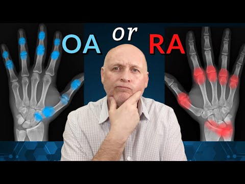 Hand Arthritis. Is it Osteo or Rheumatoid ?