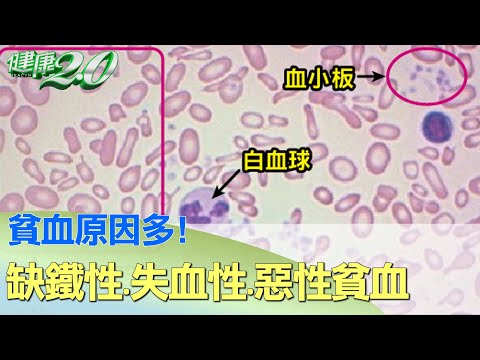 貧血原因多！缺鐵性貧血.失血性貧血.惡性貧血 健康2.0