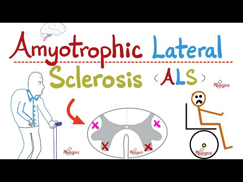 Amyotrophic Lateral Sclerosis (ALS) - Lou Gherig disease - UMNL & LMNL - Paralysis - Neurology