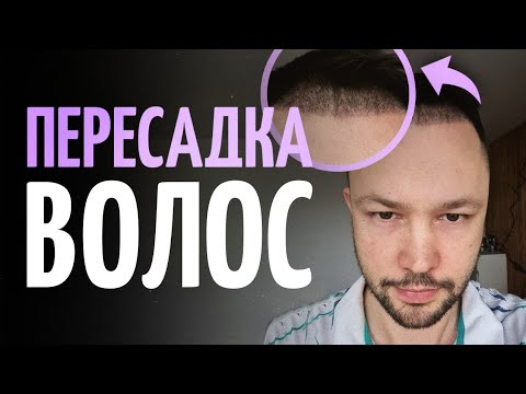 Пересадка волос и бровей. Все о процедуре. Мой личный опыт.