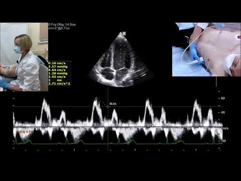Оценка диастолической функции левого желудочка (д.м.н. Шульгина Л.Э.)