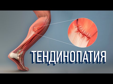 Тендинопатия. Как ее лечить? Что это такое?