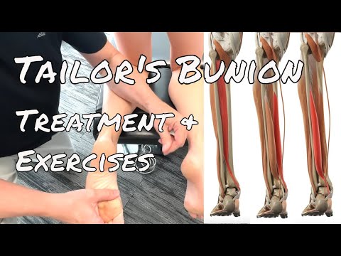 Tailor's Bunion - Treatment & Exercises