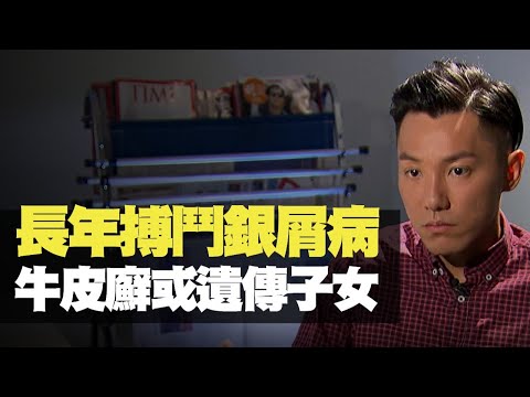 TVB News 張頴康搏鬥銀屑病 牛皮廯或遺傳子女 (最強生命線 黃靖婷 TVB News) bji 2.1
