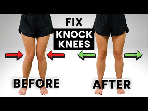 How to Fix KNOCK KNEES (without SURGERY!)