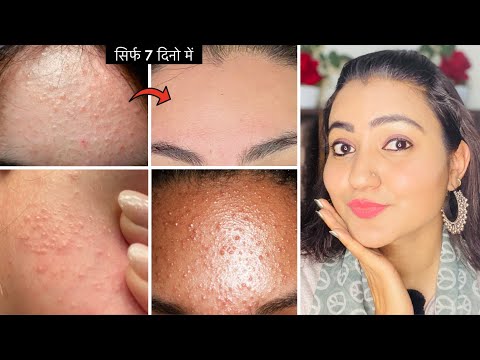 मुश्किल से मुश्किल *Tiny Bumps White Bumps* सफ़ेद दाने Uneven Skintone, Dark Spots का 100% इलाज़ 💕