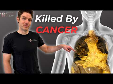 Why Cancer is So Hard to Kill