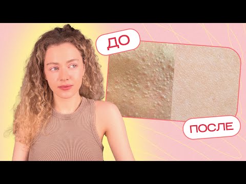 TEXTURE and uneven SKIN RELIEF - how to get rid of it?