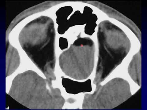 Imaging of the Paranasal Sinuses 4