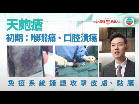 最強生命線|天皰瘡非皮膚過敏 免疫系統錯誤攻擊自身皮膚、黏膜|醫療|治療|無綫新聞|TVB News