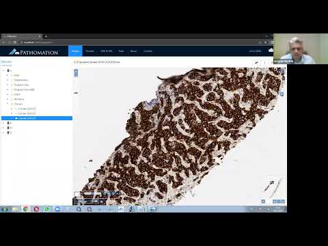 4. Холангиоцеллюлярный рак в печени