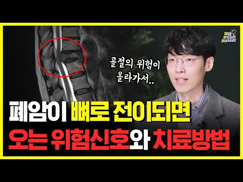 갑자기 뼈가 부러졌다고요? 알고 보니 폐암이 퍼진 것 이였습니다