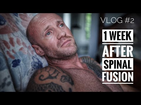 Spinal Fusion 1 week after L5-S1 PLIF and nerve repair (what to expect)