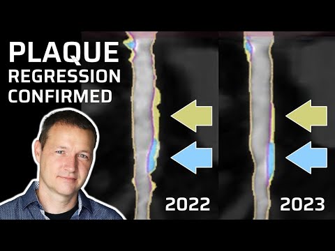 New KETO-CTA Data - Clarification and Update on Cleerly