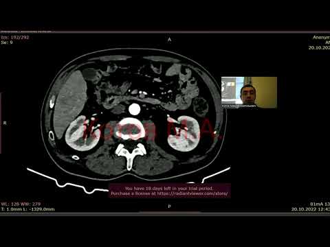 Анализ КТ живота