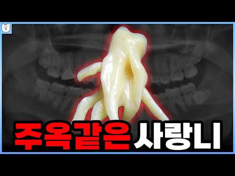 왜 얘는 맨날 매복하고 있는 걸까? ｜요즘은 사랑니를 이렇게 써먹는다