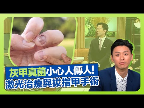 健康360 TVB｜灰甲真菌小心染全身人傳人!  陳厚毅醫生分析成因｜口服藥、激光治療與拔指甲手術｜嚴重倒甲行路都痛!｜流行都市 安德尊 謝芷倫 焦浩軒