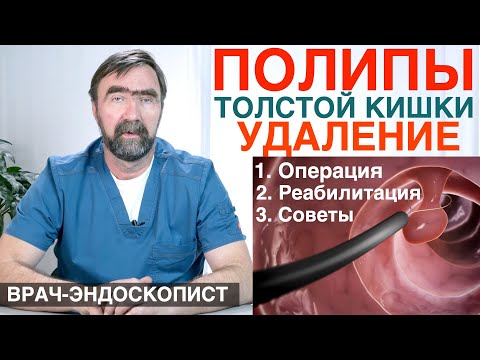 ПОЛИПЫ ТОЛСТОЙ КИШКИ - удаление полипов кишечника, ОПЕРАЦИЯ, осложнения,рекомендации после удаления