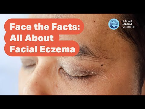 Webinar: Face the Facts—All About Facial Eczema