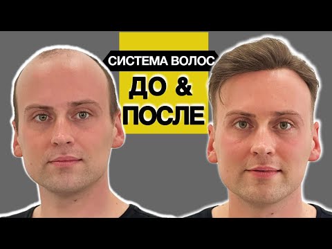 Жизнь в системе волос несколько лет, заметно ли? Ассортимент систем волос при алопеции у мужчин.