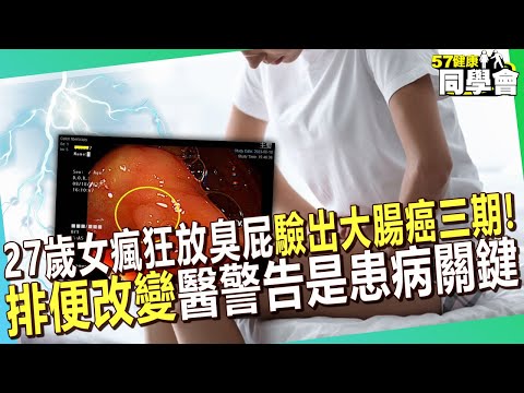 【精選】27歲女「瘋狂放臭屁」驗出大腸癌三期崩潰！「排便改變」醫警告是患病關鍵【57健康同學會】