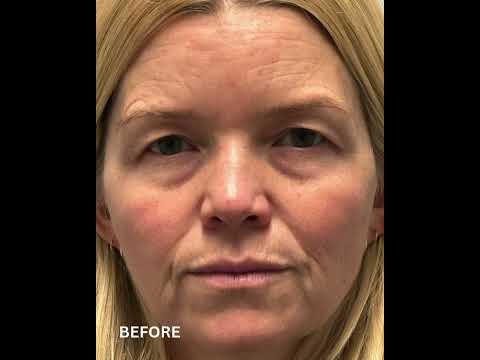 Before & After Endoscopic Brow Lift + Upper Eyelid Blepharoplasty | Dr. Kian Eftekhari