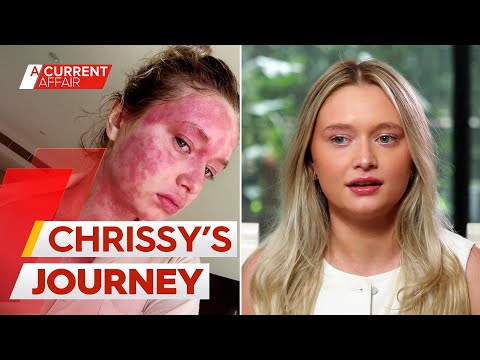 Arthritis drug clears woman's skin after 20-year eczema battle | A Current Affair