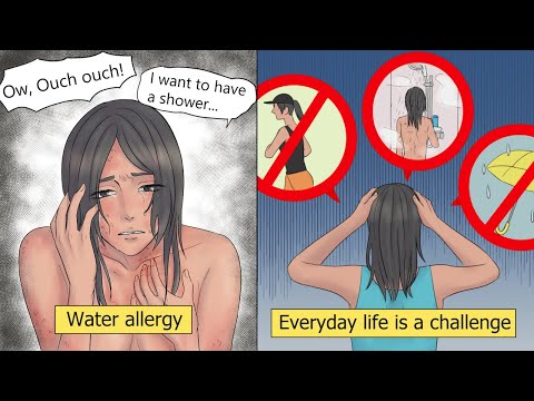 【Manga】Water allergy. A 1 in 200 million rare disease.