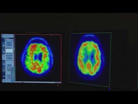 $100 million increase in federal funding for Alzheimer’s, dementia research signed into law