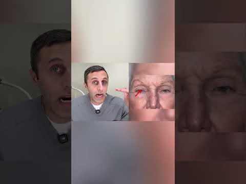 Is Your Eyelid Hiding Your Eye? Ptosis Explained Fast! #shorts