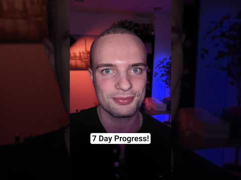 Day 7 After Getting a Hair Transplant!