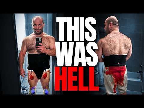 My Brutal Physique-Altering Surgery Experience  (Graphic Medical Content)