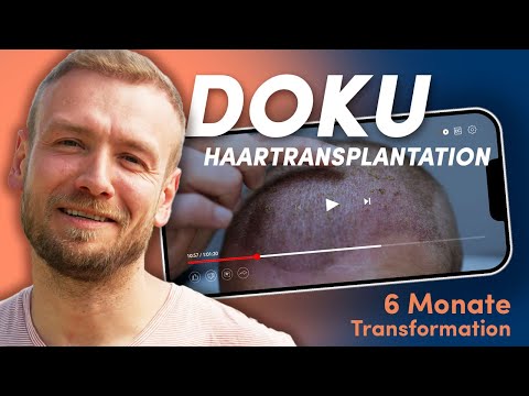 Haartransplantation Türkei: Alles, was du wissen musst | Doku