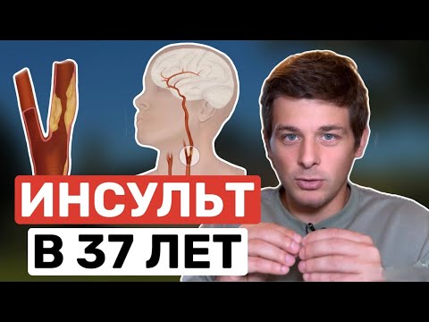 Атеросклероз сонных артерий: безмолвный убийца.