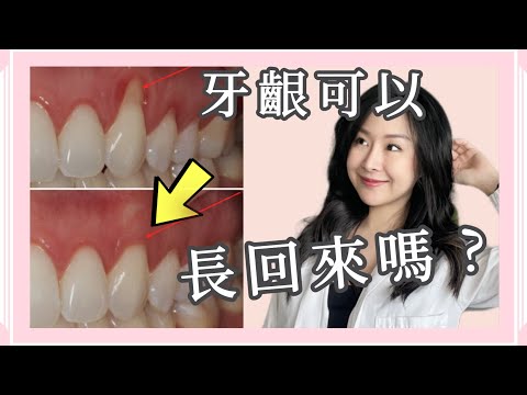 『牙齦保養必看』牙齦萎縮必須知道的五個關鍵方法！預防勝於治療！