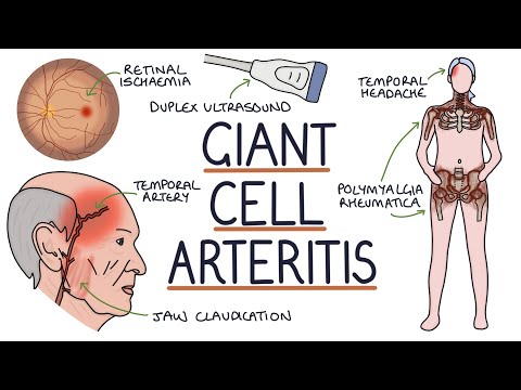 Understanding Giant Cell Arteritis (Temporal Arteritis)