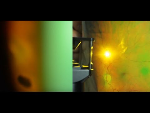 Укрепление сетчатки лазером. Лечение сетчатки глаза