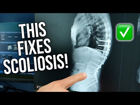 How Spinal Fusion Helps Straighten Your Spine