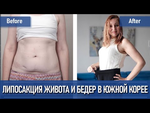 Липосакция и абдоминопластика в Южной Корее | Часть I