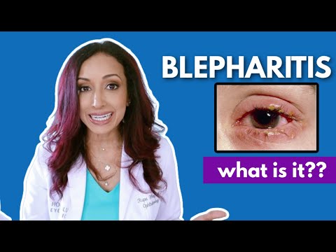 What Is Blepharitis? Eye Doctor Explains