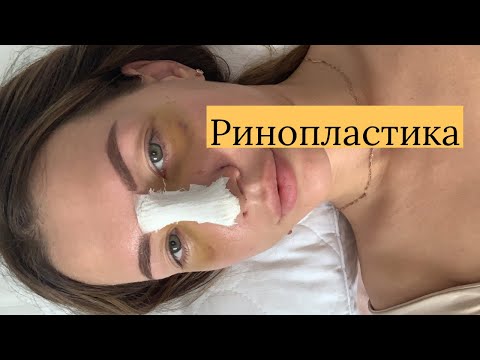 Ринопластика. Снятие гипса. До и после ринопластики. Ответы на вопросы.Пережила общий наркоз