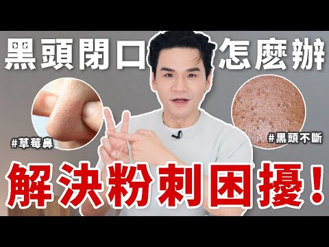 👃#粉刺 真的能清乾淨嗎?怎麽正確保養避免 #黑頭 #閉口?一次終結你的所有粉刺問題!✨