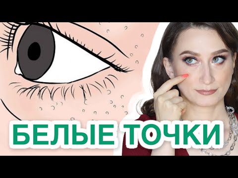 Милиумы - это болезнь❓ИЗБАВЛЯЕМСЯ НАВСЕГДА❗️