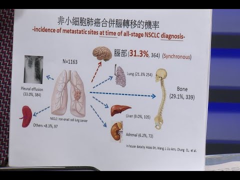 【名醫妙方】認識肺癌晚期的治療與「腦轉移」2022.08.01